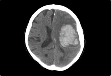 neurosurgery-3